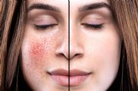 Light Therapy and Skin Conditions [How it Treats Rosacea, Eczema, & Psoriasis]